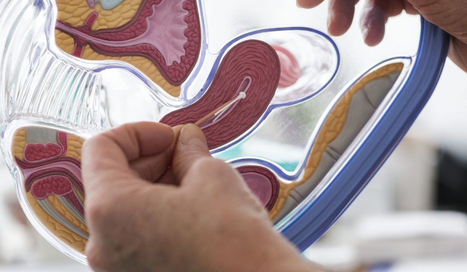 Des stérilets à régler cash chez le gynéco 1